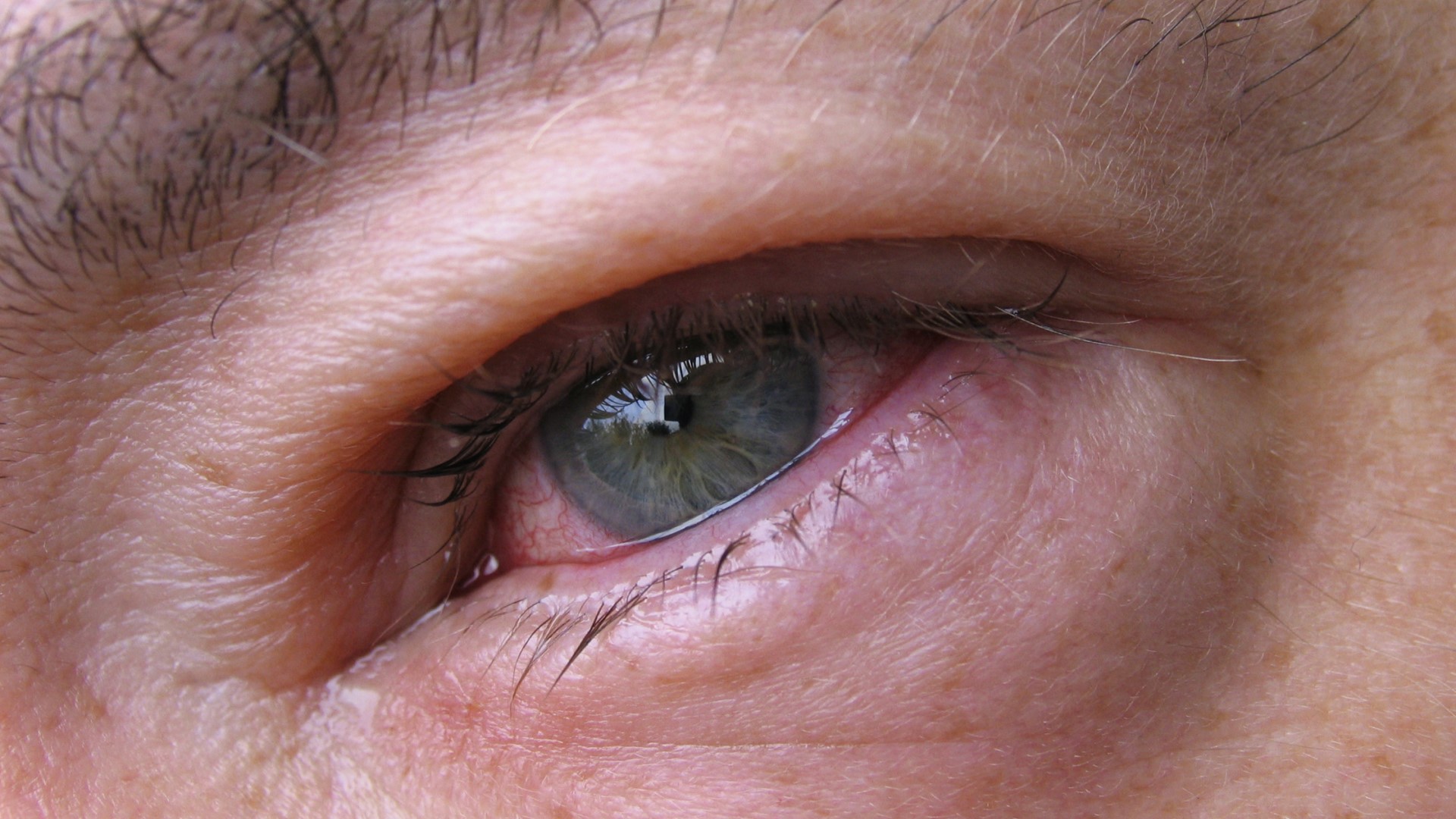 Заболеваниями заболеваний глаз появиться. Блефарит конъюнктивит. Блефарит блефароконъюнктивит. Ангулярный конъюнктивит.